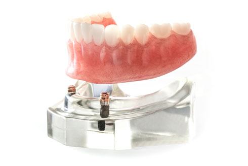 impant-retained-overdentures Implant Retained Overdentures